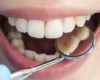 Penyebab Karang Gigi dan Cara Mengatasinya