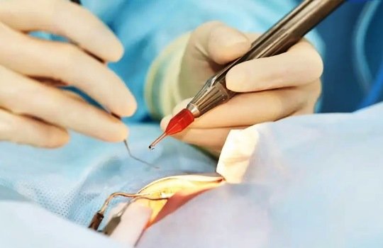 Mengenal LASIK Mata Solusi Efektif untuk Masalah Penglihatan Anda