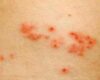 Kenali Gejala Herpes Zoster dan Cara Menanganinya dengan Bijak Sebelum Terlambat