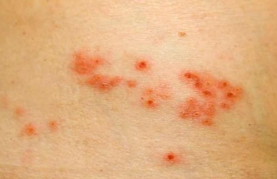 Kenali Gejala Herpes Zoster dan Cara Menanganinya dengan Bijak Sebelum Terlambat